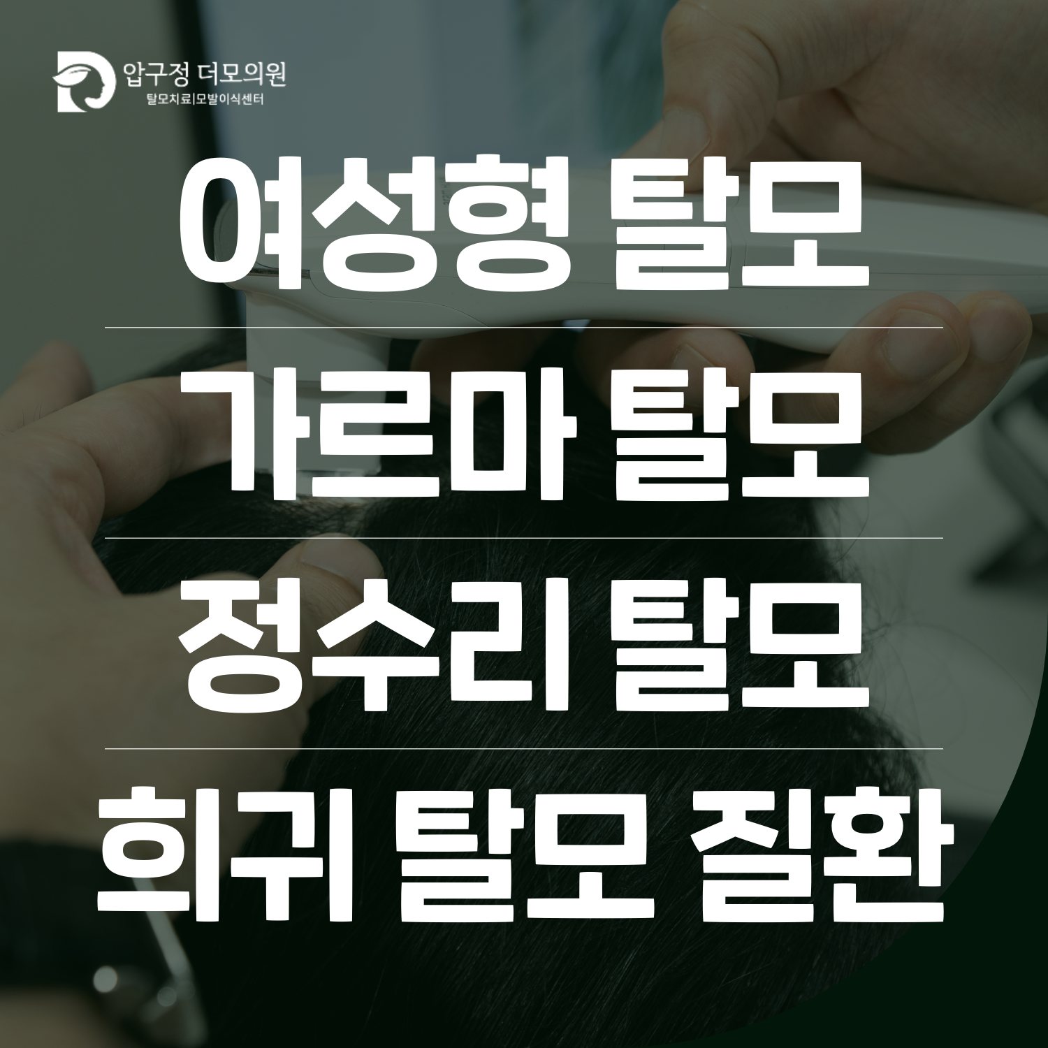 압구정탈모 원형탈모, 작은 동그란 빈자리도 치료해야 하나요?