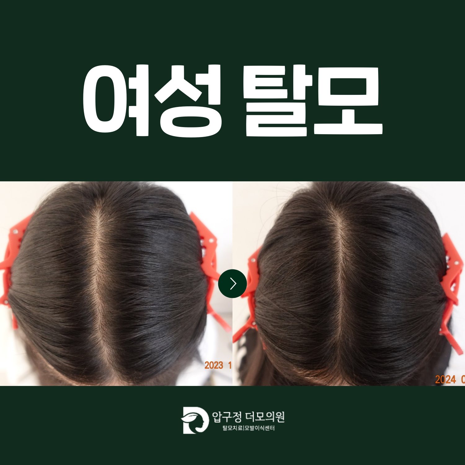 압구정탈모 진료, 여성탈모는 출산이나 다이어트 때문일까요?