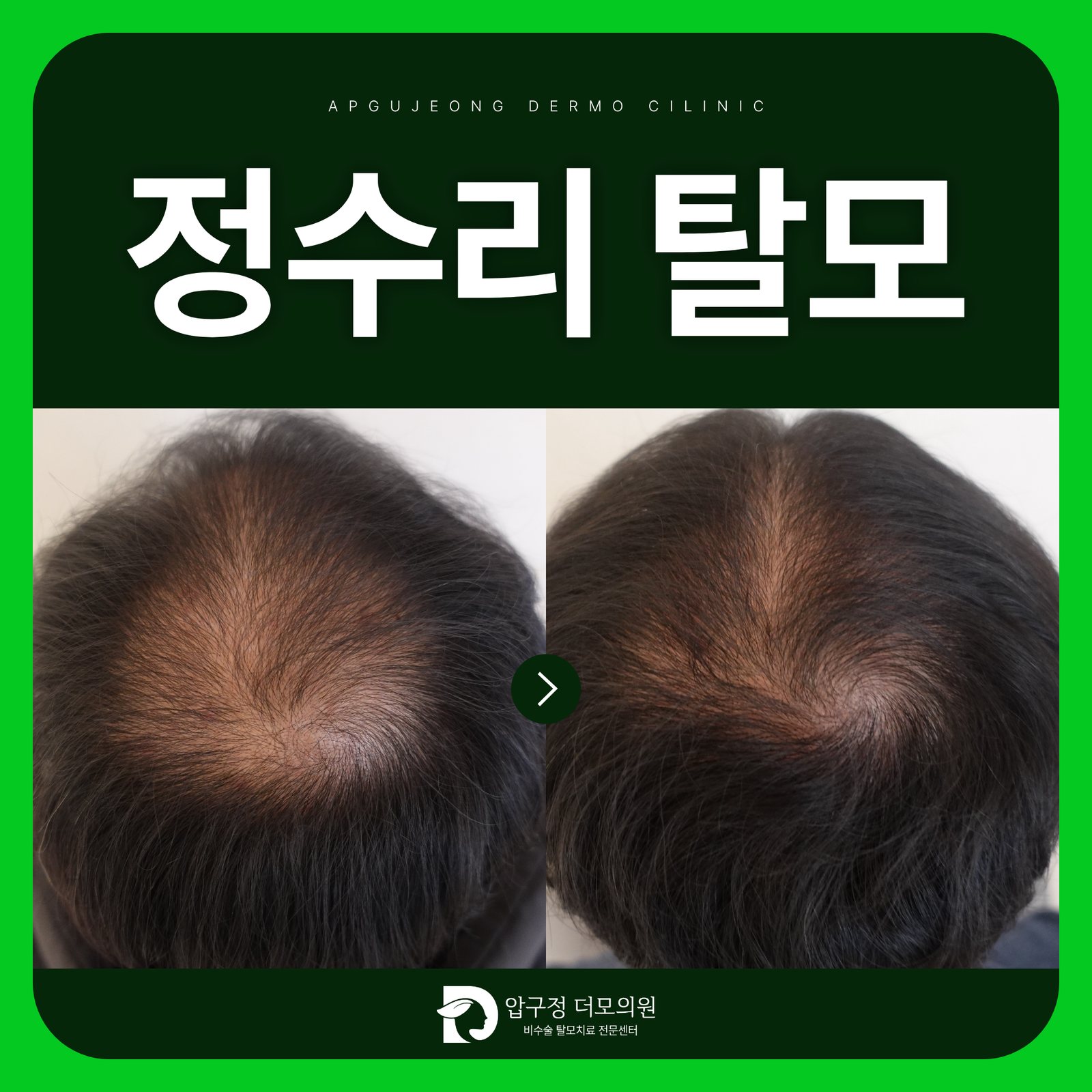 강남탈모 진료, 정수리가 비쳐 보이면 이미 탈모가 진행된 걸까요?