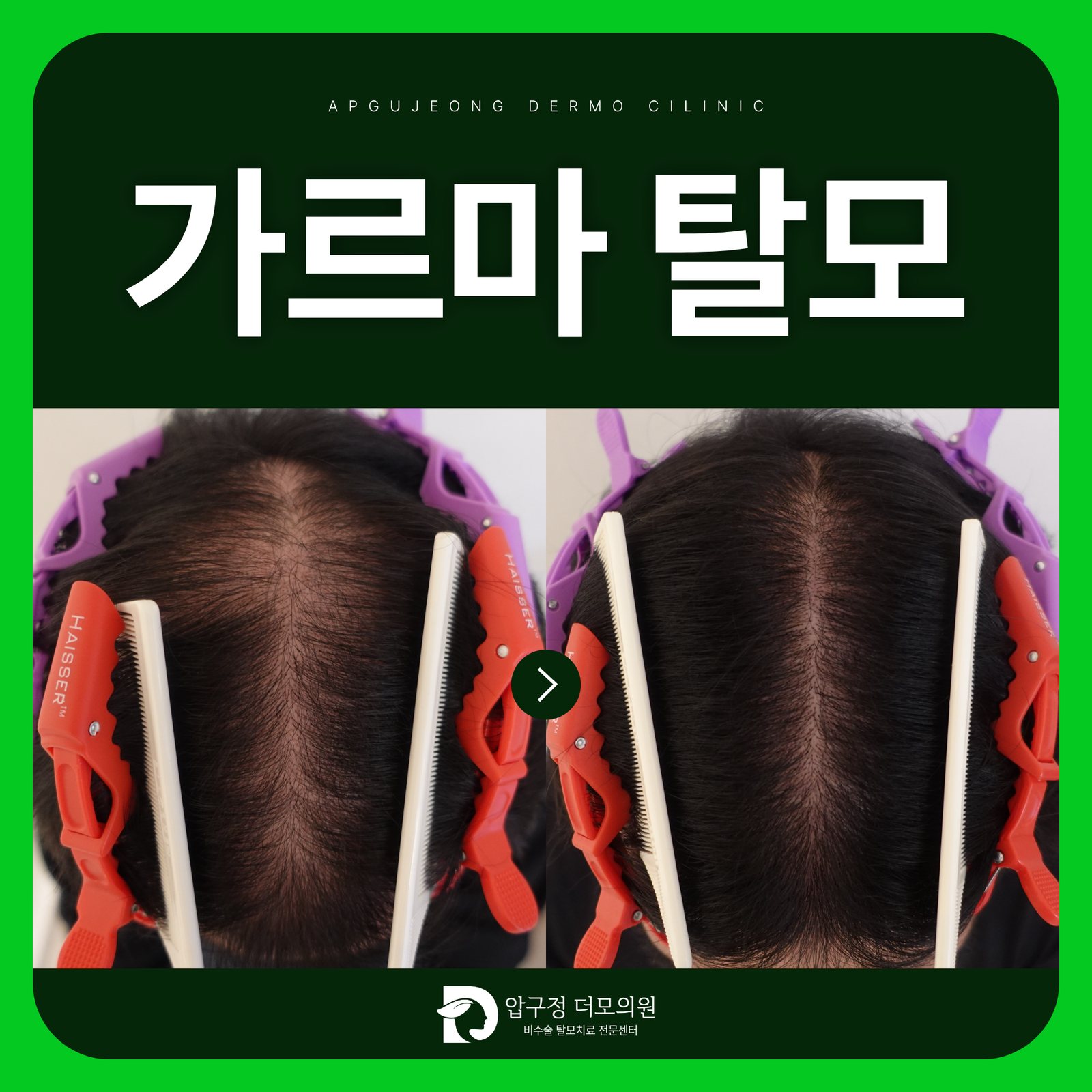 강남탈모병원에서 보는 가르마탈모, 가르마를 바꾸면 좋아질까요?