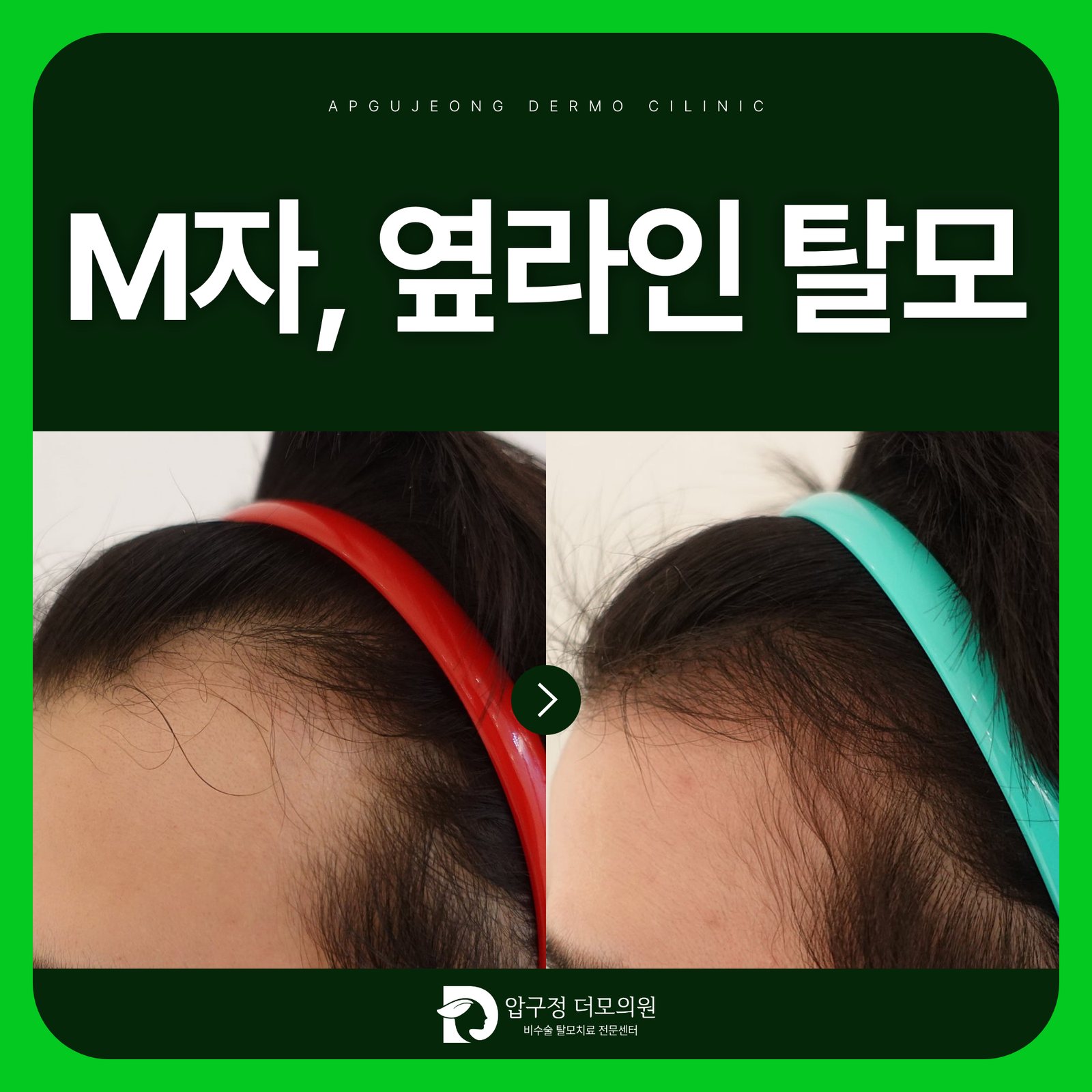 압구정탈모 진료, M자와 옆머리의 빈자리는 원인이 같을까요?